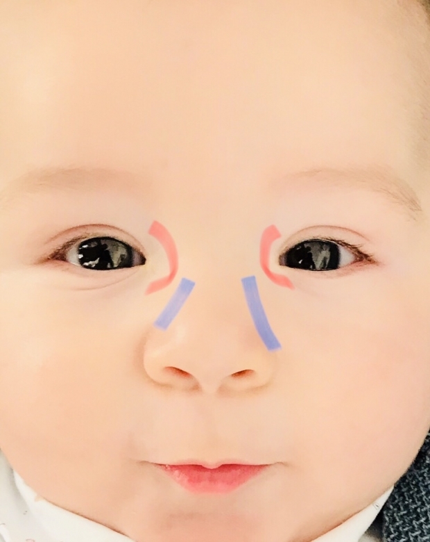 Masáž očných vrhov u detí