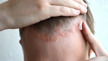 Aké sú príznaky seboroickej dermatitídy a kto sa prejavuje? Potraviny, ktoré vyvolávajú chorobu