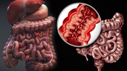 Čo je Crohnova choroba? Aké sú príznaky Crohnovej choroby? Existuje liek na Crohna?