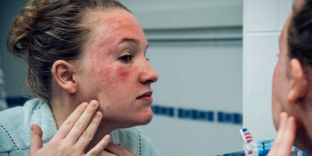 objavujú sa na koži u osoby so studenou alergiou