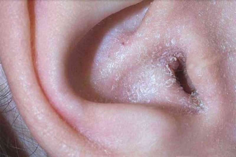 Čo spôsobuje olupovanie za uchom a ako to prechádza? Definitívne riešenie pre ekzém za ušami ...