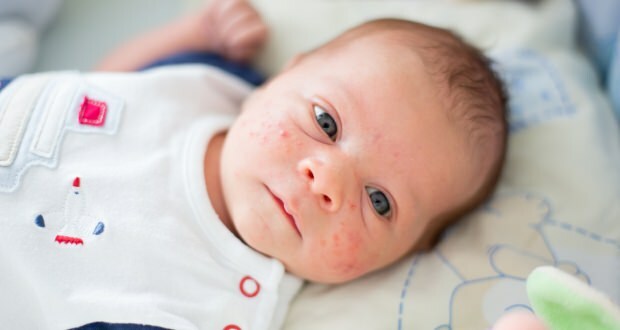 Ako akné prechádza na detskú tvár? Metódy sušenia akné (Milia)