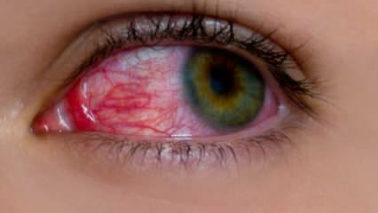 Čo spôsobuje očné alergie? Aké sú príznaky očnej alergie? Čo je dobré pre alergie na oči? 
