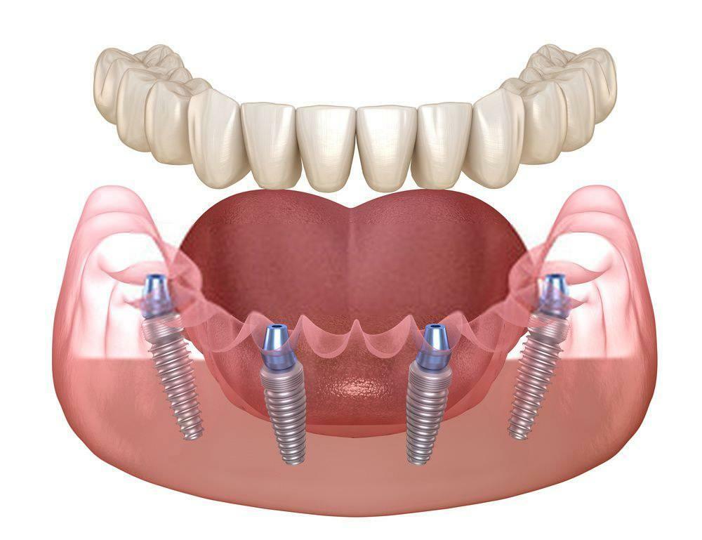 MÔŽEM UMIESTNÚŤ IMPLANTÁT IHNEĎ PO EXTRAKCII ZUBOV?