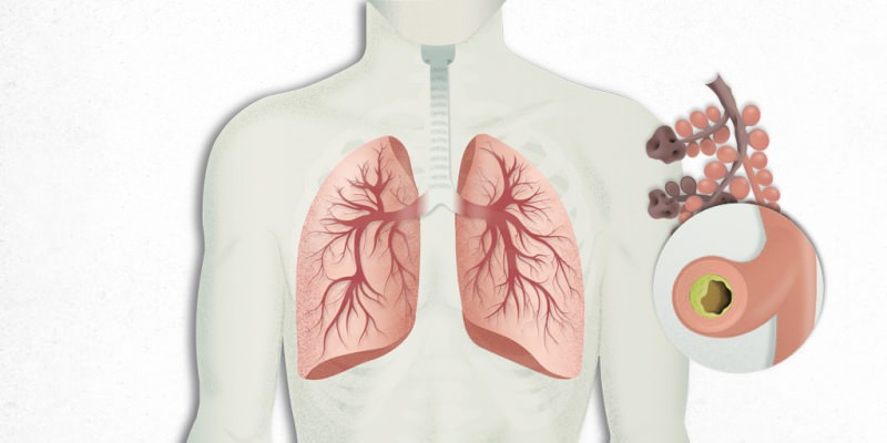 vírus, ktorý sa usadzuje v pľúcach, je zmiešaný s pneumóniou