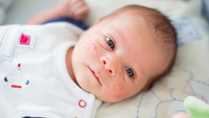 Ako akné prechádza na detskú tvár? Metódy sušenia akné (Milia)