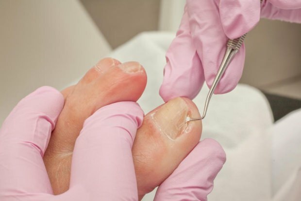 Čo spôsobuje zarastanie nechtov na nohách a aké sú príznaky? Prirodzené spôsoby, ktoré sú dobré na zarastanie nechtov ...