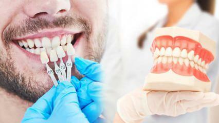 Prečo sa na zuby aplikuje zirkónová dyha? Ako odolný je zirkónový povlak?