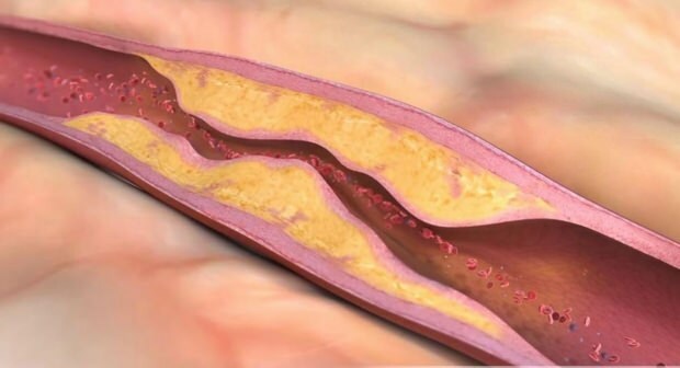 Čo spôsobuje aterosklerózu? Koľko druhov vaskulárnej oklúzie existuje?