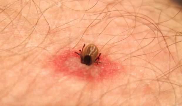 Aké je uhryznutie hmyzom? Príznaky bodnutí hmyzom! Prírodná metóda na uhryznutie komárom