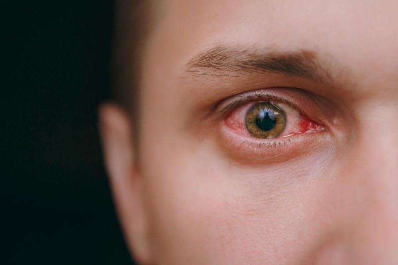 zalievanie očí, krvácanie a svrbivé príznaky koronavírusu