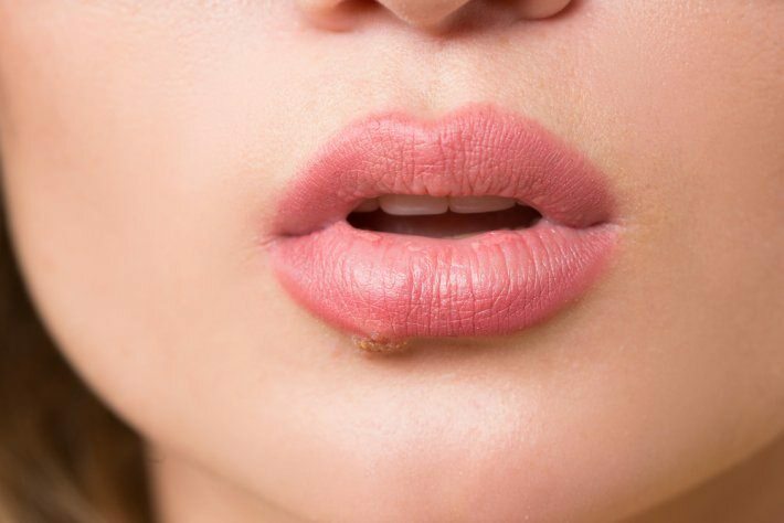 Čo je to rakovina jazyka? Aké sú príznaky?