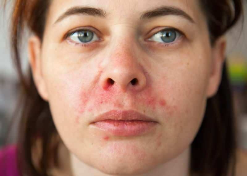 Prečo sa okolo pery objavuje akné? Ako sa lieči periorálna dermatitída?