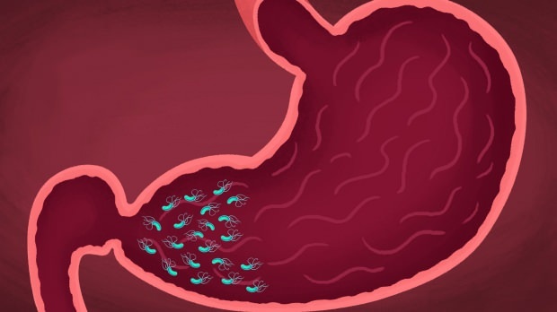 niektoré vírusy a baktérie môžu spôsobiť gastritídu