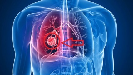 Príznaky rakoviny pľúc: štádiá rakoviny pľúc!