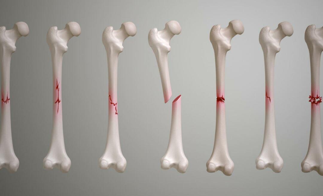 Čo je kľúčna kosť? Ako dlho trvá, kým sa zlomenina kľúčnej kosti zahojí?