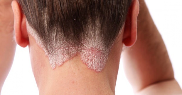 Príznaky a liečba seboroickej dermatitídy