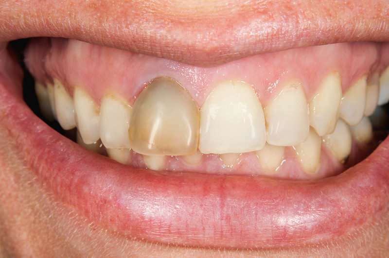 stmavnutie zubov sa niekedy môže sústrediť na jeden zub