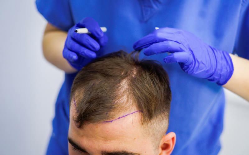 Je prípustné transplantovať vlasy pri liečbe vypadávania vlasov? Čo sú protetické vlasy? Narúša protetické vlasy ghusl?