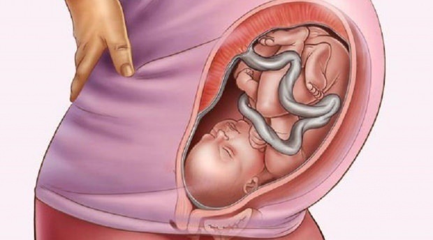 Čo je placenta previa?