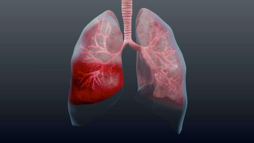 Čo je zápal pľúc a aké sú jeho príznaky? Ako sa lieči nový epidemický vírus pneumónie?