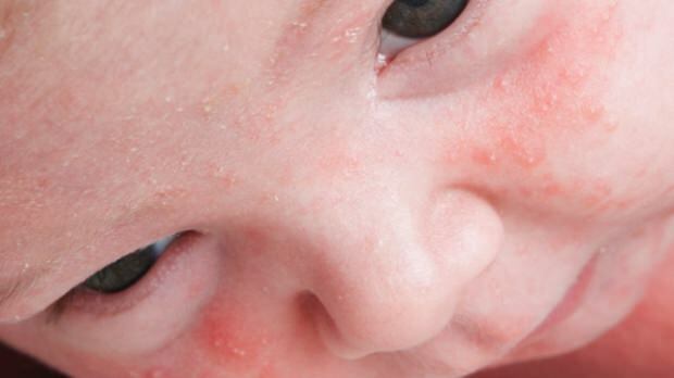 Ako akné prechádzajú u dojčiat?