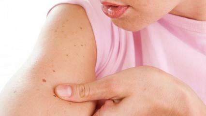 Čo je rakovina kože (kože) a aké sú jej príznaky? Spôsoby, ako pochopiť rakovinu kože