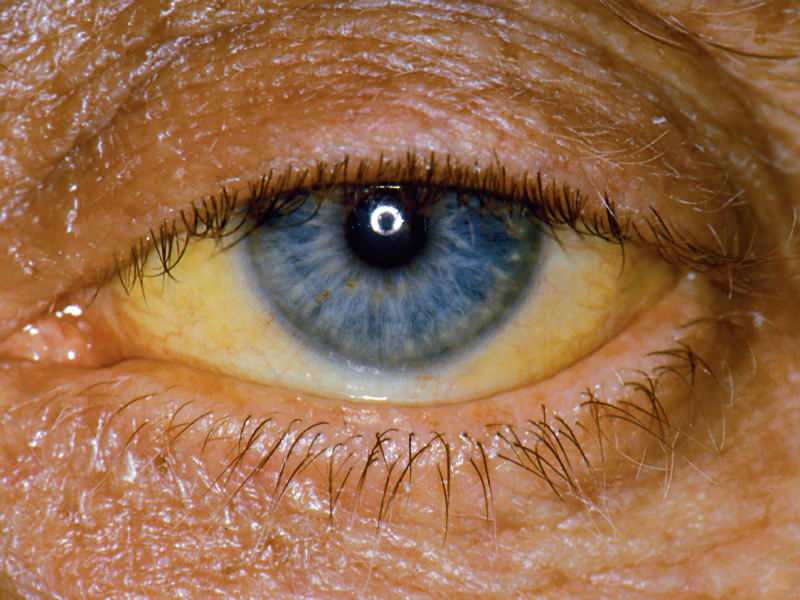 Výška na úrovni bilirubínu spôsobuje žltú farbu očí a pokožky