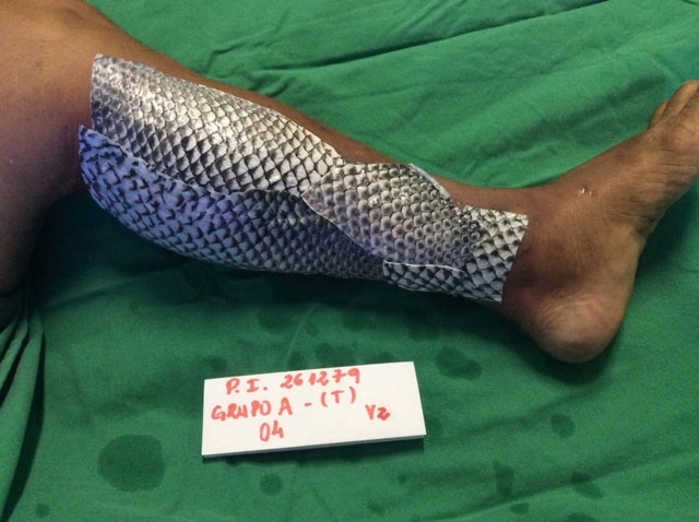 Koža z rýb prešla pri liečení popálenín do anamnézy