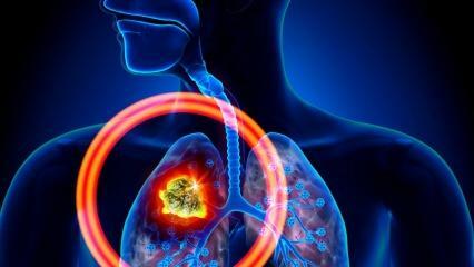 Aké sú príznaky rakoviny pľúc? Existuje liečba rakoviny pľúc?