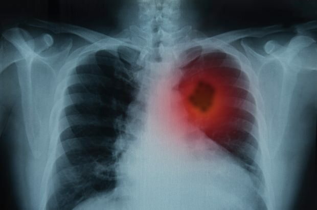 Aké sú príznaky rakoviny pľúc? Existuje liečba rakoviny pľúc? Ako zabrániť rakovine pľúc ...