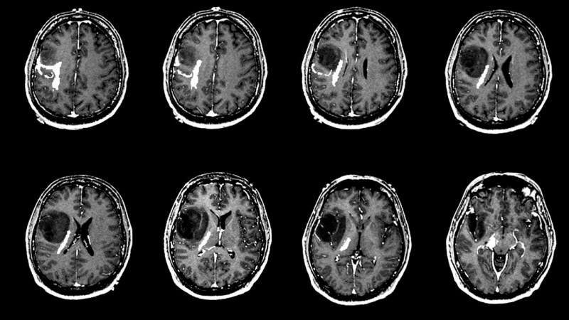 Čo spôsobuje nádor na mozgu? Aké sú príznaky nádoru na mozgu? Je liečba nádoru na mozgu zložitá?