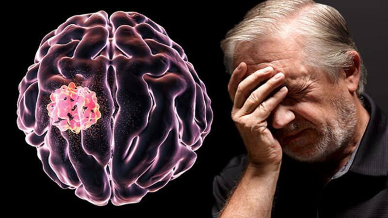 Tkanivo tvorené v mozgu narušením bunkových štruktúr sa nazýva nádor.