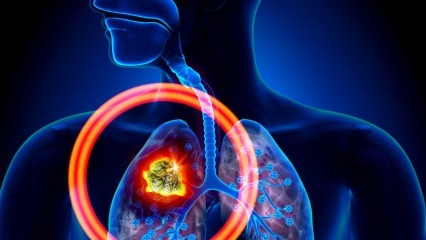 Aké sú príznaky rakoviny pľúc? Existuje liečba rakoviny pľúc? Ako zabrániť rakovine pľúc ...