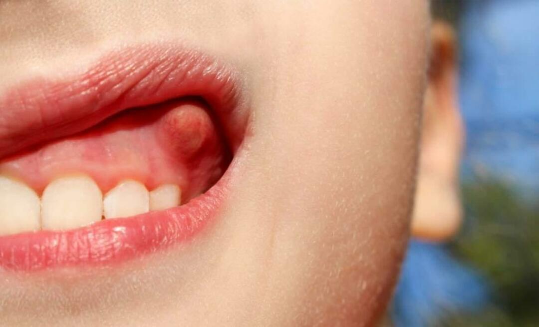 Prečo zub absces a aké sú príznaky? Zubný absces, ako sa lieči?