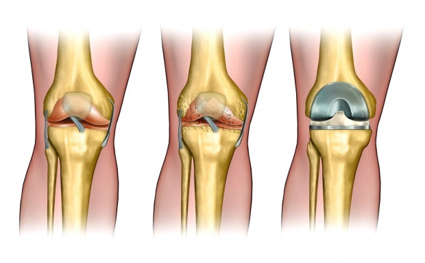 Ochorenia ako artritída vedú k úľave od bolesti