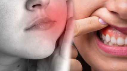 Čo spôsobuje zubný absces? Aké sú príznaky a za koľko dní? Prírodné riešenie zubného abscesu...
