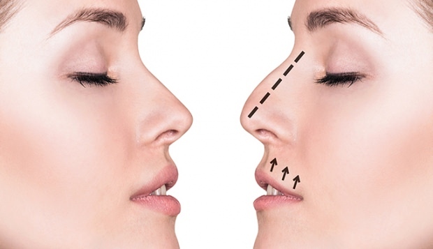 Ako sa vykonáva operácia nosa? V ktorých prípadoch sa vykonáva operácia nosa?