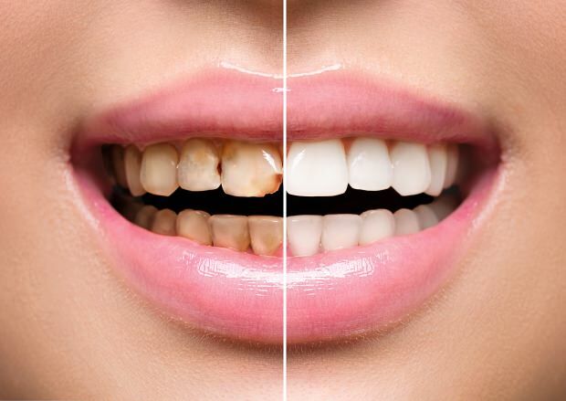 V dôsledku nezdravej výživy dochádza k sfarbeniu zubov aj k strate zubov
