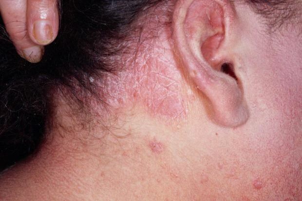 Aké sú príznaky seboroickej dermatitídy a kto sa prejavuje? Potraviny, ktoré vyvolávajú chorobu