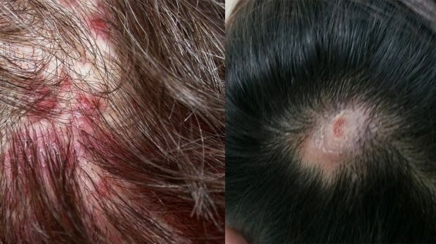 Prečo sa akné objavuje na pokožke hlavy? Ako prenikajú pupienky na pokožku hlavy?