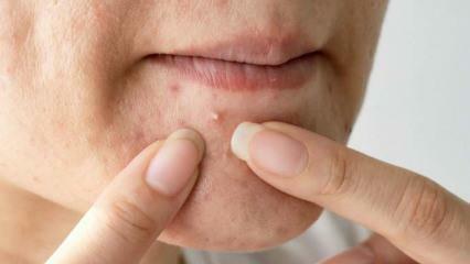 Prečo sa na brade objavuje akné? Prírodné riešenie pre akné na brade