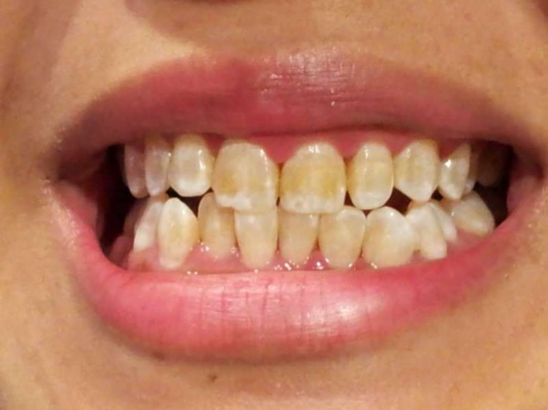 zubný obraz osoby, ktorej zuby začínajú stmavnúť