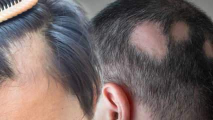 Čo je kožušina (Alopecia areata)? Čo sú príznaky kožného ochorenia? Efektívne riešenia pre kožného ochorenia