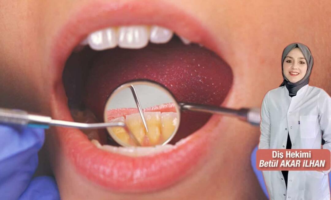 Čo robiť, aby ste sa vyhli zubnému kameňu? Aké sú výhody zubného kameňa?