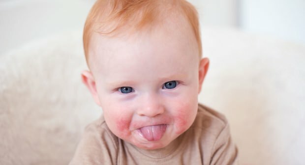 Pozornosť u bábätiek s červenými tvárami! Syndróm facky na tvári a jeho príznaky