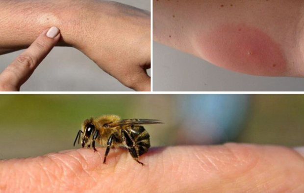 príznaky alergie na včely