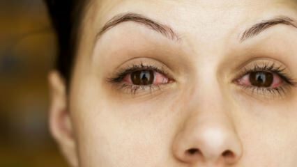 Čo je konjunktivitída (očná chrípka) a aké sú jej príznaky? Ako sa prenáša zápal spojiviek?