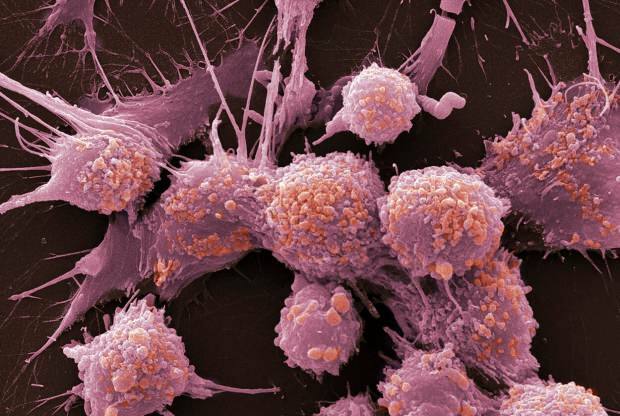 Čo je rakovina a aké sú jej príznaky? Koľko druhov rakoviny existuje? Ako sa predchádza rakovine?