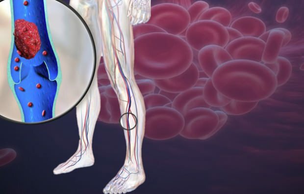 znížený krvný obeh v žilách nôh spôsobuje bolesť